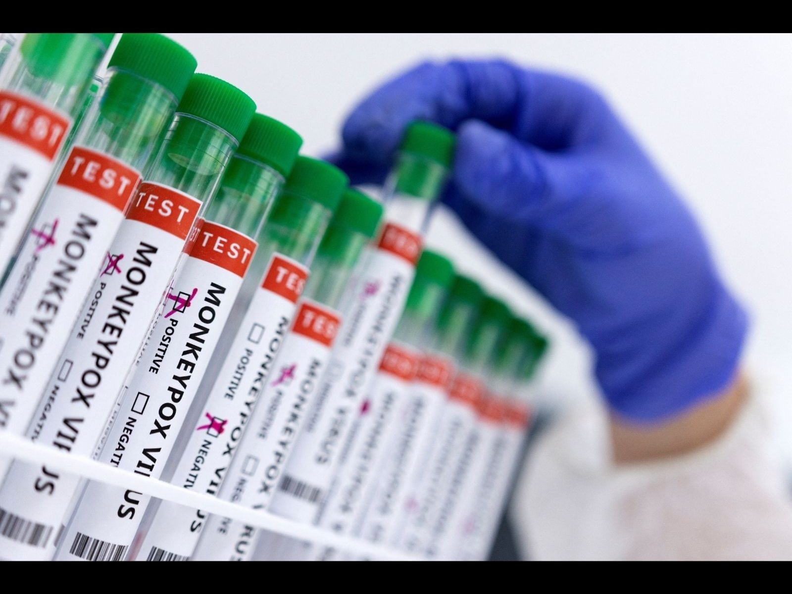 Delhi reports fresh case of Monkeypox! Nigerian woman tests positive