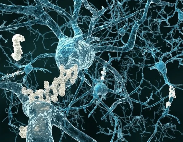 Blood tests are best at detecting Alzheimer's disease
