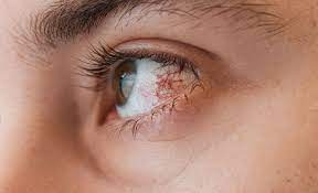 Eyes, allergies and monsoon: Tips on coping with seasonal eye allergies in rainy season