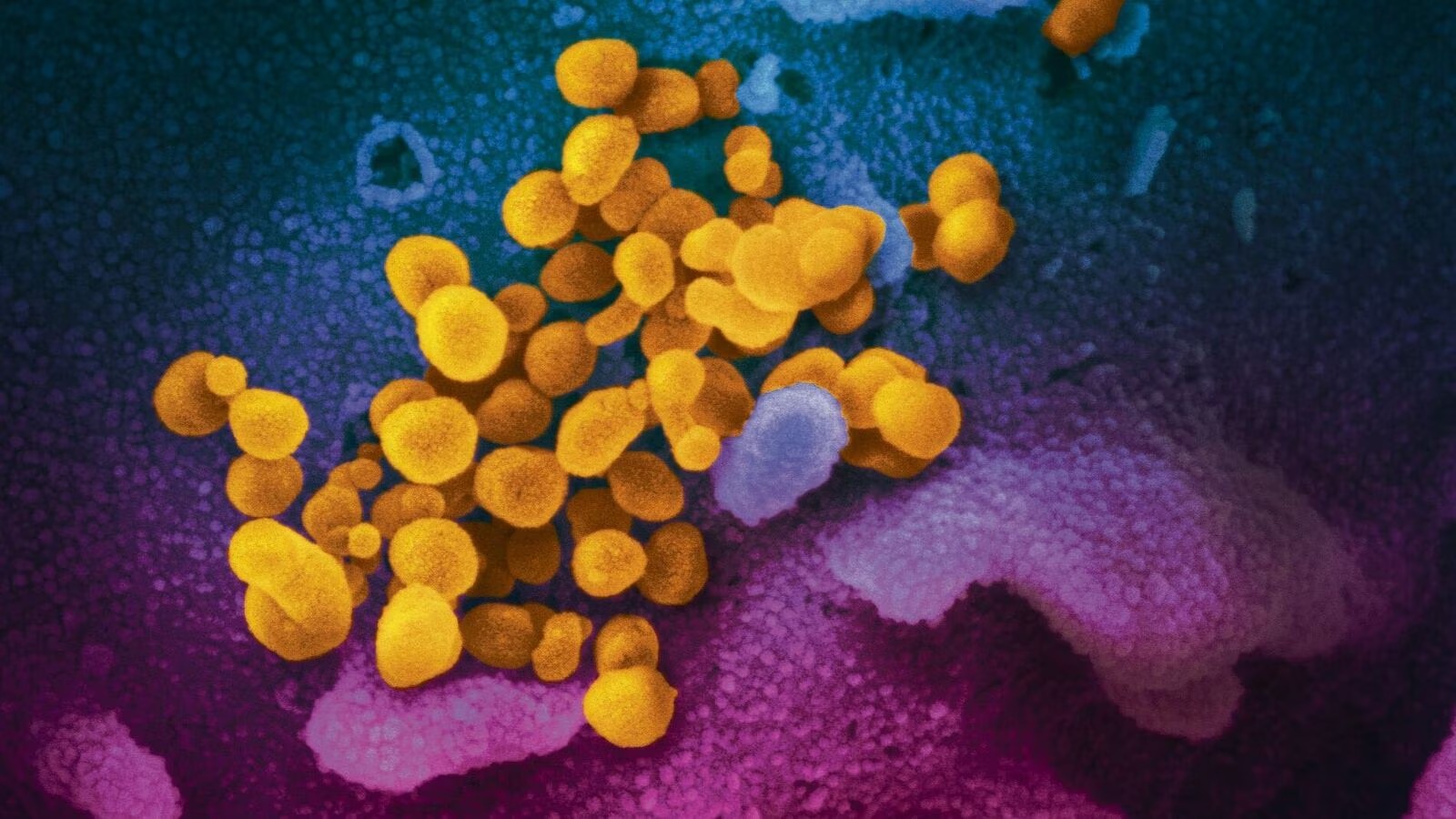 SARS-CoV-2 emerging in US, immunity levels are waning', warns US epidemiologist